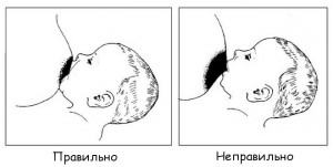 Лактостаз причини, симптоми, самостійне лікування, мазі, апаратні засоби та заходи