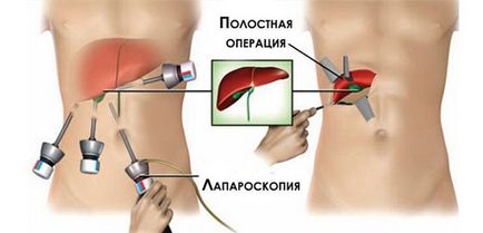 Лапароскопія жовчного міхура свідчення і обмеження, хід операції