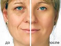 Rejuvenarea faciala laser (complet) - preturi la moscow, 208 preturi gasite