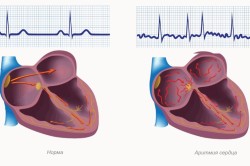 Tratamentul aritmiilor cardiace cu remedii folclorice