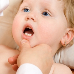 Лікування молочниці в роті у дитини народними засобами і препаратами