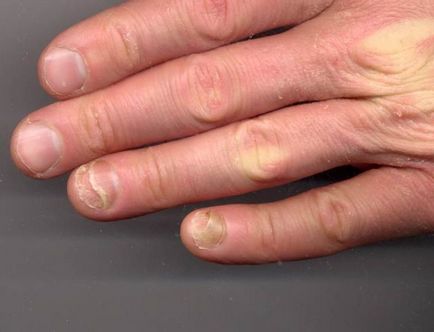 Лікування нігтів, хвороби нігтів