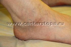 Tratamentul piciorului longitudinal cu implanturi de artroheroză subtartar