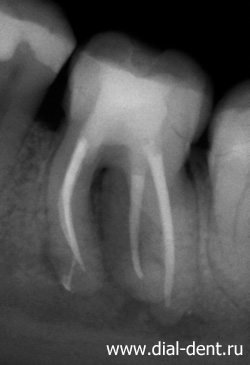 Krónikus apikális periodontitis