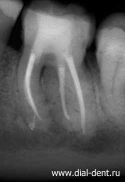 Krónikus apikális periodontitis