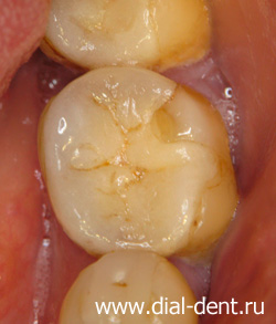 Krónikus apikális periodontitis