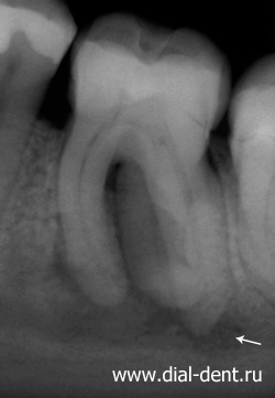 Krónikus apikális periodontitis