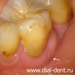 Krónikus apikális periodontitis