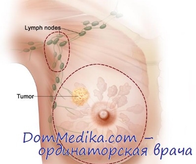 Metacronează cancerul de sân