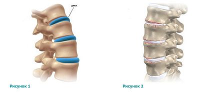 Osteochondroza intervertebrală - simptome ale tuturor părților coloanei vertebrale