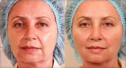 Mezoniti pentru facelift (tredlifting)