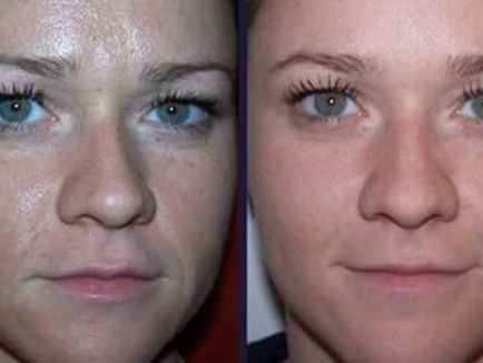 Mandula peeling arc véleménye, eljárás leírása, annak előnyeit és hátrányait (leírás) Mandula peeling arc véleménye, eljárás leírása, annak előnyeit és hátrányait