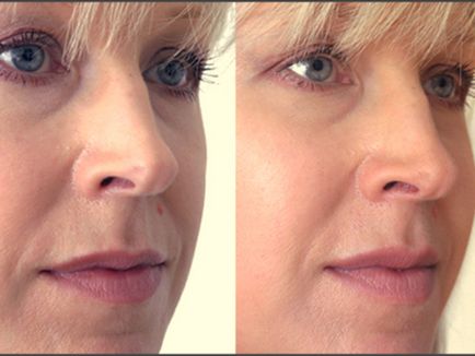 Mandula peeling arc véleménye, eljárás leírása, annak előnyeit és hátrányait