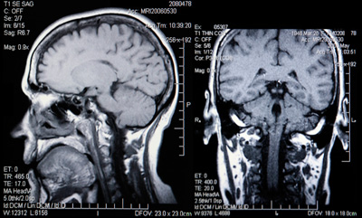 MRI az agyalapi mirigy és a sella