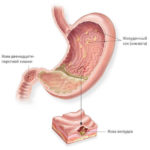 Mucosa compositum használati utasítást, ár, áttekintésre, analógok