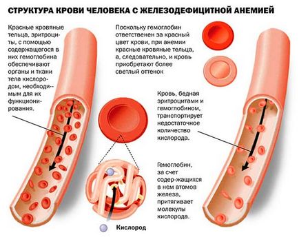 Lipsa de fier în organism simptome și semne, care este norma, preparate pentru reaprovizionarea fierului