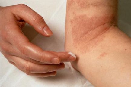 Az atópiás dermatitis terhesség alatt okoz az, tünetek, kezelés