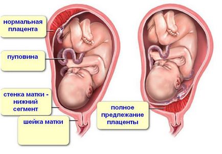 Alacsony placentatio terhesség alatt