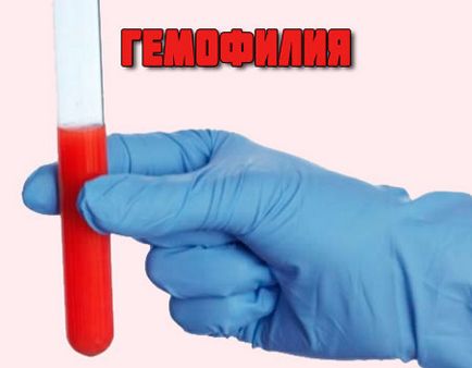 Nou în tratamentul hemofiliei