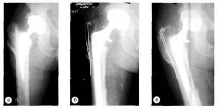 Ускладнення після ендопротезування кульшового суглоба періпротезние переломи стегнової кістки