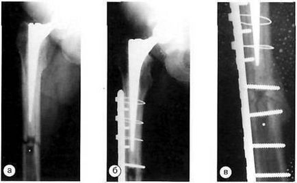 Ускладнення після ендопротезування кульшового суглоба періпротезние переломи стегнової кістки
