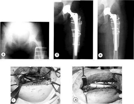 Ускладнення після ендопротезування кульшового суглоба періпротезние переломи стегнової кістки
