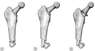 Ускладнення після ендопротезування кульшового суглоба періпротезние переломи стегнової кістки