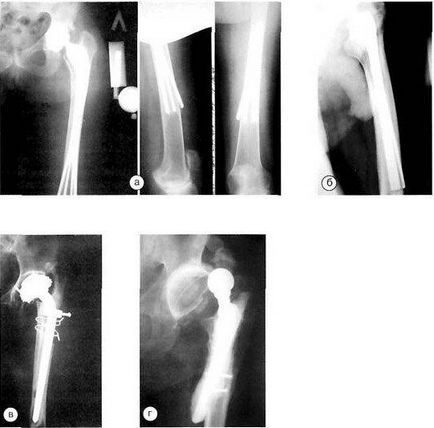 Utáni szövődmények csípő protézis körül arthroplasticán combcsonttörések