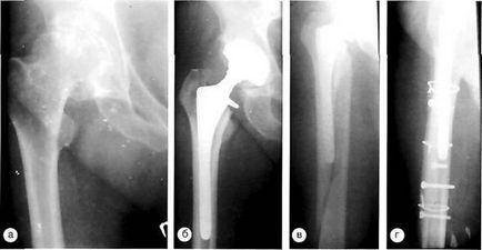 Ускладнення після ендопротезування кульшового суглоба періпротезние переломи стегнової кістки