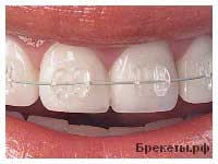 Complicații după ortodonție (bretele)