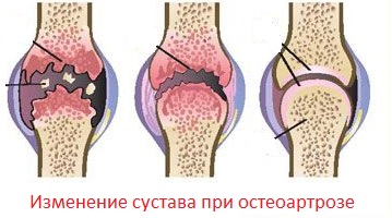 Simptomele osteoartritei, tratamentul, cauzele, diagnosticul