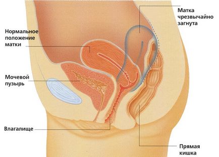 Devirarea uterului posterior - ce amenință și cum trebuie tratat