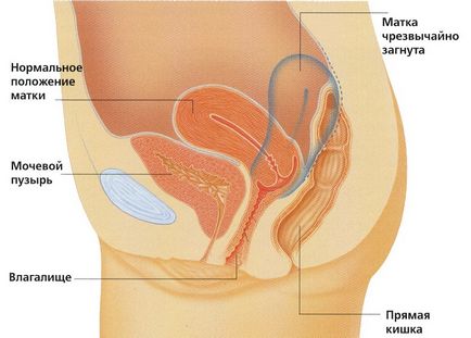 Відхилення матки назад - чим загрожує і як лікувати