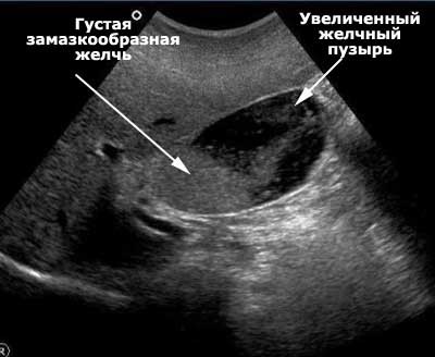 Mozgáskorlátozottak epehólyag ultrahang - egészségesen élni