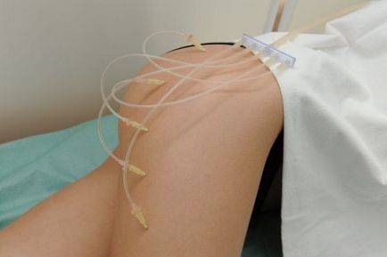 Ózon javallatok és ellenjavallatok, előnyei és hátrányai a kezelések (bizonyság) Ózon javallatok és ellenjavallatok, előnyei és hátrányai kezelések