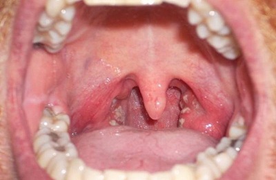 Papilloma în gât (pe amigdală și limbă) simptome și tratament