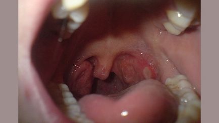 Папілома в горлі (на мигдалині і язичку) симптоми і лікування
