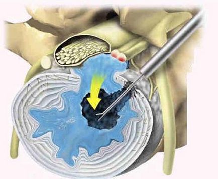 Paravertebral block