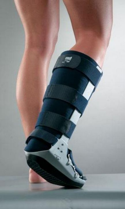 Fibula törés tünetek, jelek, diagnózis és kezelés (kezelés) Fibula törés tünetek, jelek, diagnózis és kezelés