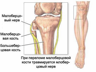 Fibula törés tünetek, jelek, diagnózis és kezelés