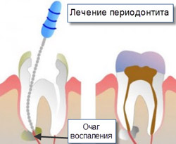 Tratamentul parodontitei parodontitei acute și cronice a dinților - metode și prețuri