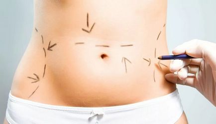 Abdominoplastia - abdominoplastia