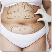 Chirurgie abdominală - clinică estetică