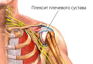 Плескіт плечового суглоба симптоми і лікування народними засобами