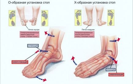 Плоскостопість у дорослих причини, лікування, профілактика