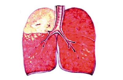 Pneumonie cu simptome, tratament și cauze de tuberculoză pulmonară