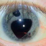 De ce ochii se ud și ce se poate face cu acest tratament la ochi acasă