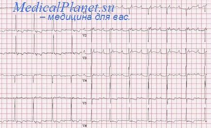 Полярність комплексу qrs