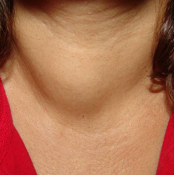 Наслідки вузлів у щитовидній залозі
