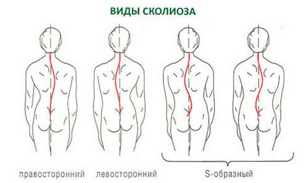 Правобічний сколіоз симптоми, лікування і вправи (відео)